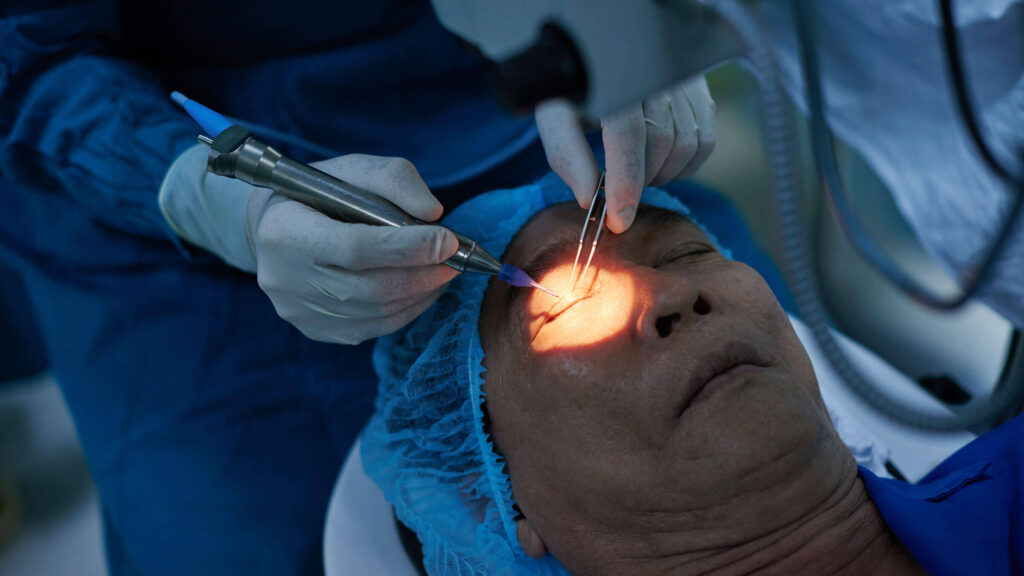 Cataract Operation Cost in Australia